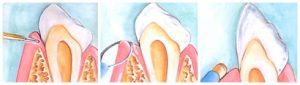 Gingivectomie