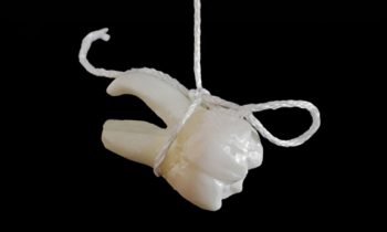 Extracția dentară