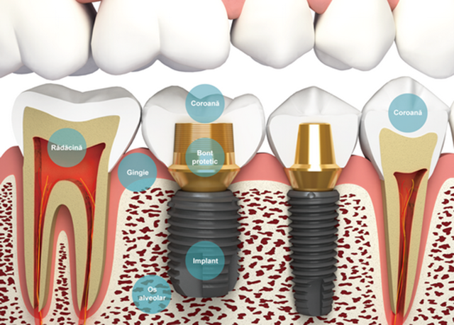 Implant - Clinica stomatologica