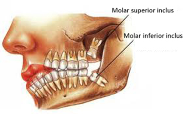 odontectomia
