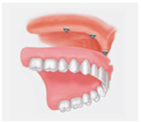 proteza pe implant