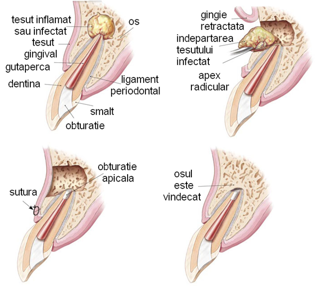 Rezectia